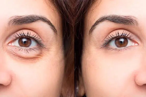 Blefaroplastia No Quirúrgica