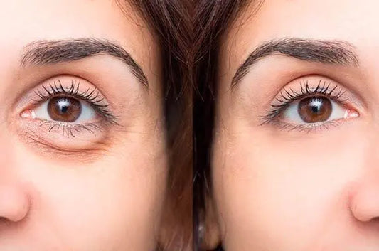 Blefaroplastia No Quirúrgica - Clinica Altos Del Desierto