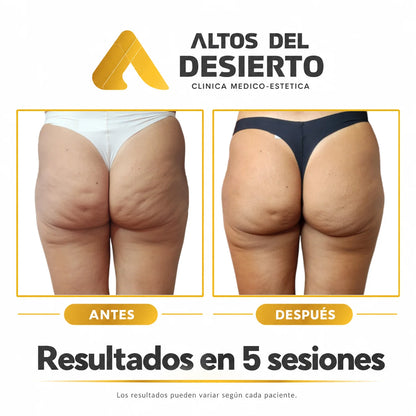 Celulitis - Pack 5 sesiones Alidya