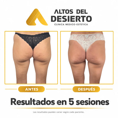 Celulitis - Pack 5 sesiones Alidya