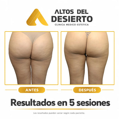 Celulitis - Pack 5 sesiones Alidya