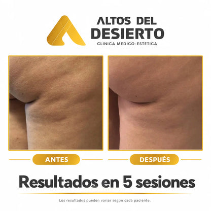 Celulitis - Pack 5 sesiones Alidya
