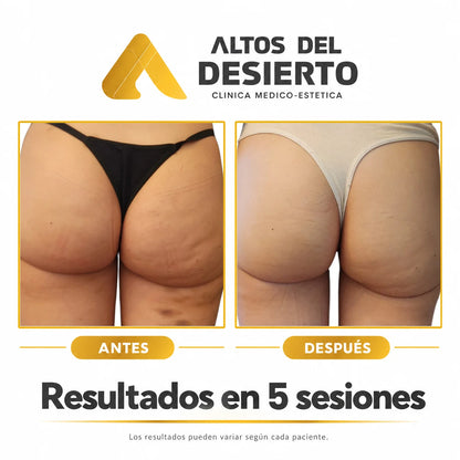 Celulitis - Pack 5 sesiones Alidya