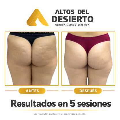 Celulitis - Pack 5 sesiones Alidya