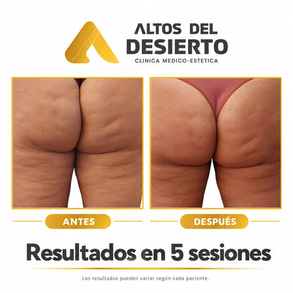 Celulitis - Pack 5 sesiones Alidya