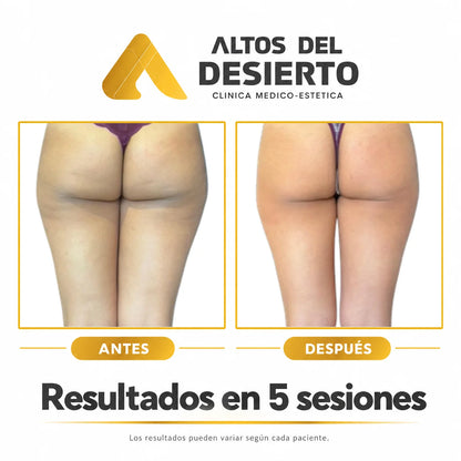 Celulitis - Pack 5 sesiones Alidya