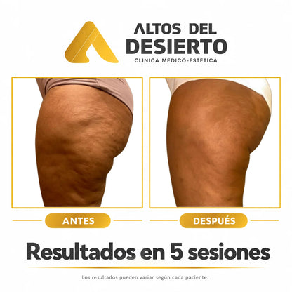 Celulitis - Pack 5 sesiones Alidya