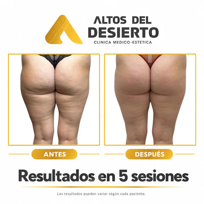 Celulitis - Pack 5 sesiones Alidya